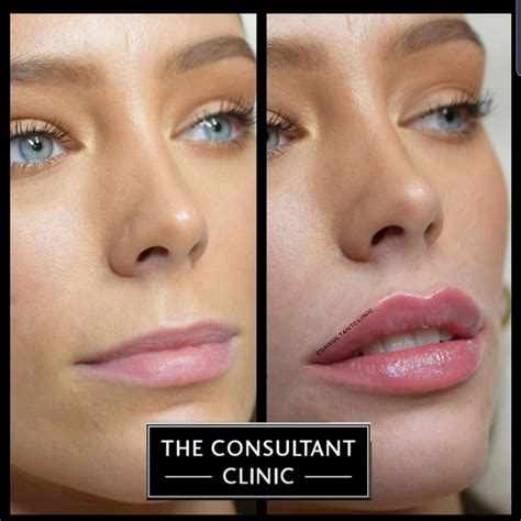 botox and lip fillers ava|More.